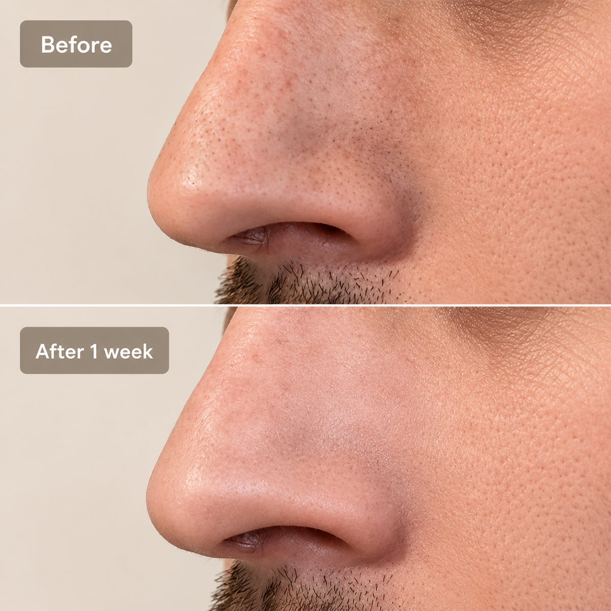 Hydrogel Nose Patches