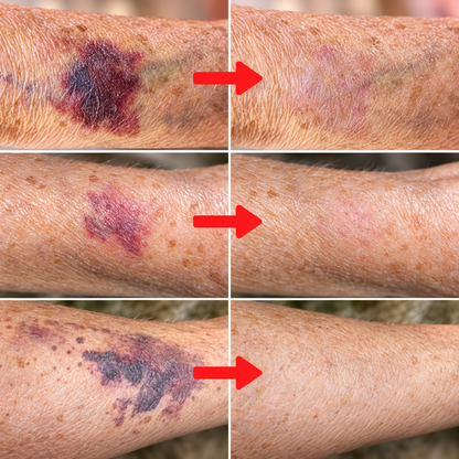 Bruise Reduction Derma Restore Serum With Arnica, Vitamin K & Ceramides
