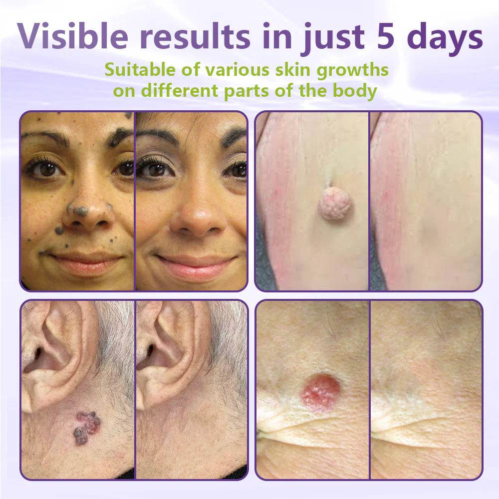 MicroNeedle Botanic Skin Tag Removal Patch