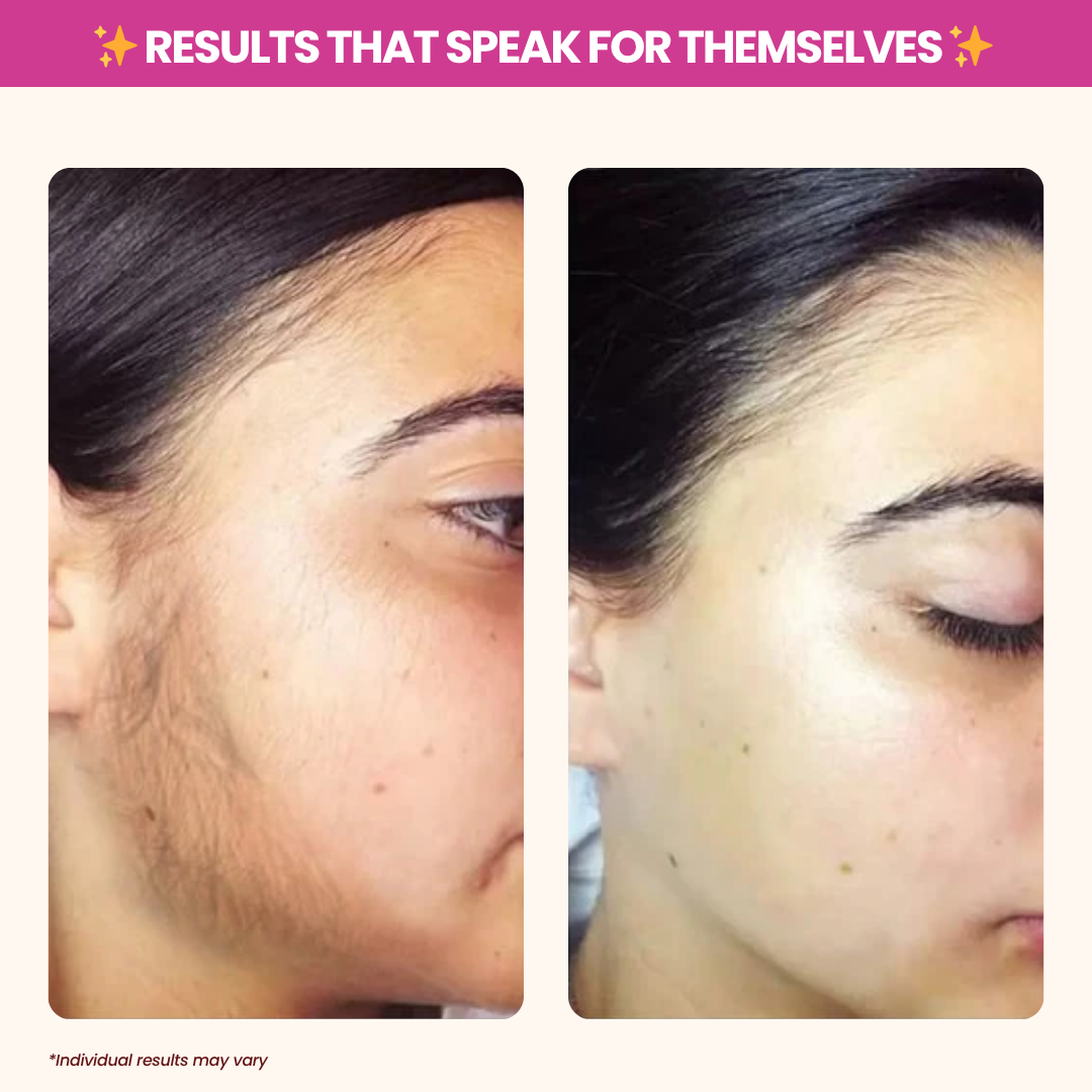 Cyperus Rotundus Oil for Hair Reduction