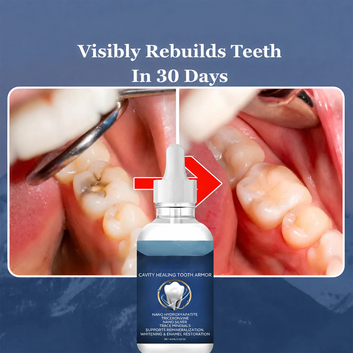 Hydroxyapatite Enamel Protective Tooth Armor
