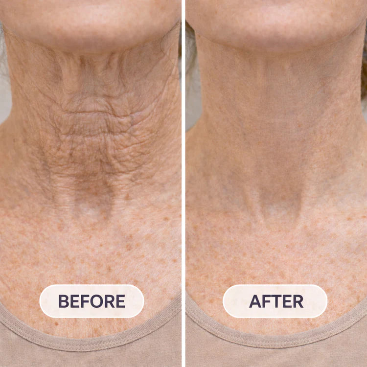 Before and after neck visual