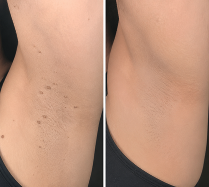 2-in-1 Microneedle & Hydrocolloid Skin Care Patches