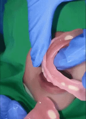 Natural Looking Dentures