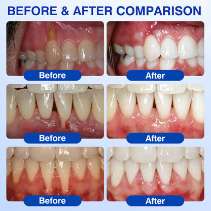 Before and after gum comparison set one