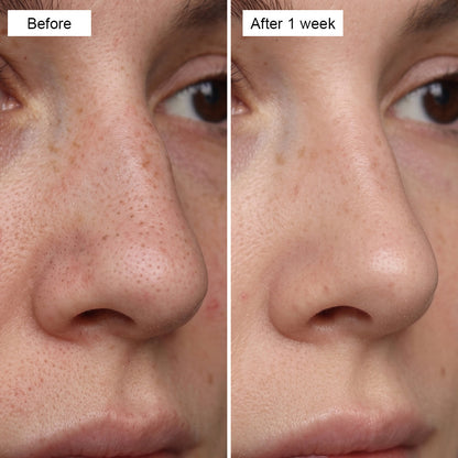 Hydrogel Nose Patches